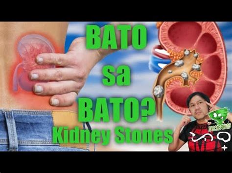 Mga Bato sa Kidney .